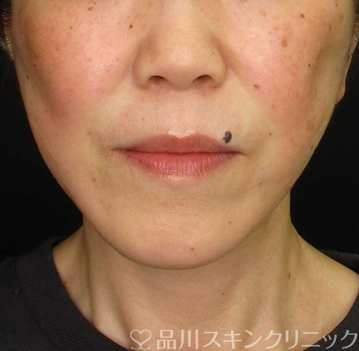 症例NO.69789のAFTER写真