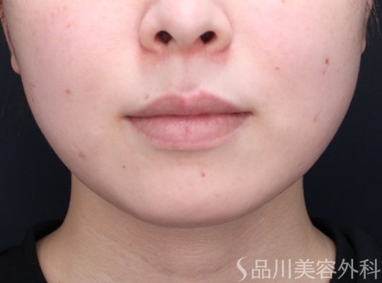 症例NO.71544のBEFORE写真