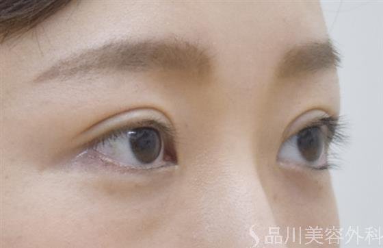 症例NO.51782のAFTER写真