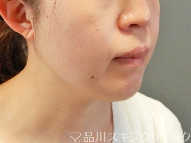 症例NO.63176のAFTER写真