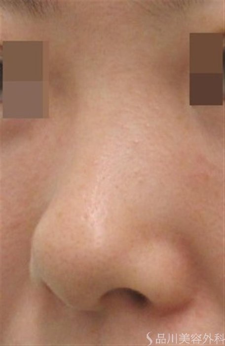 症例NO.20341のBEFORE写真