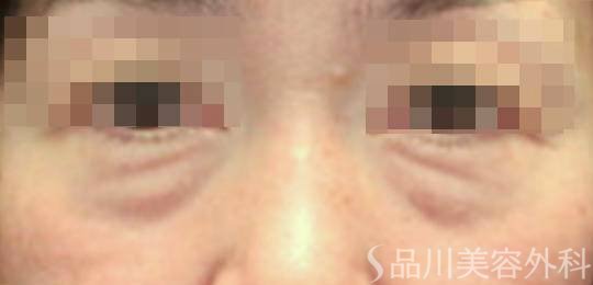 症例NO.73775のBEFORE写真