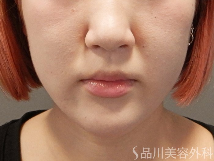 症例NO.71601のAFTER写真
