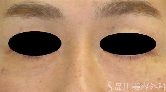 症例NO.47822のAFTER写真
