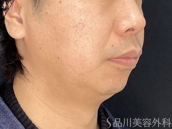 症例NO.75396のAFTER写真