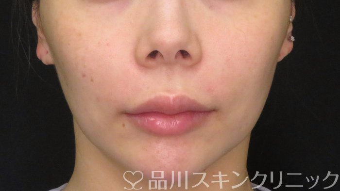 症例NO.70882のBEFORE写真