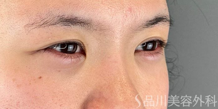 症例NO.70305のAFTER写真