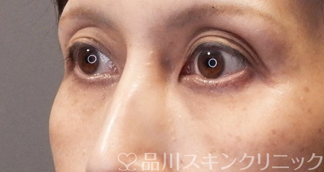 症例NO.67975のBEFORE写真