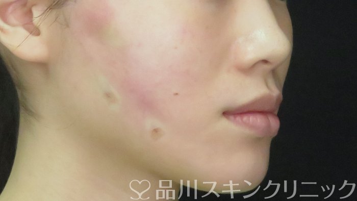 症例NO.71557のAFTER写真