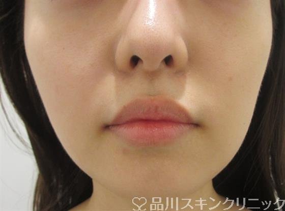 症例NO.33126のBEFORE写真