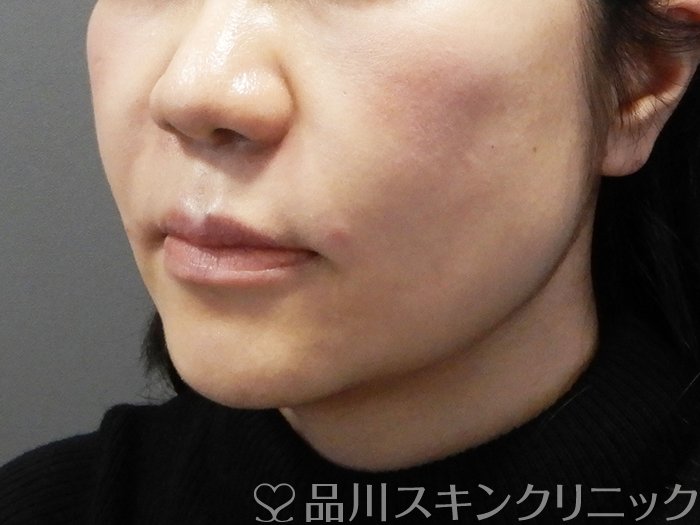 症例NO.73000のAFTER写真