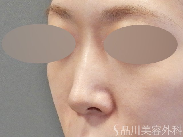 症例NO.64935のBEFORE写真