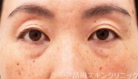 症例NO.61882のBEFORE写真