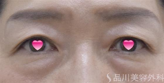 症例NO.52440のBEFORE写真