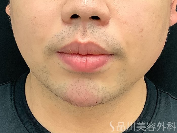 症例NO.67909のAFTER写真