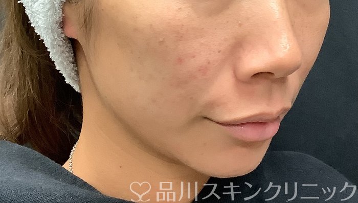 症例NO.67961のBEFORE写真