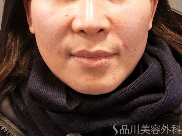 症例NO.67959のAFTER写真