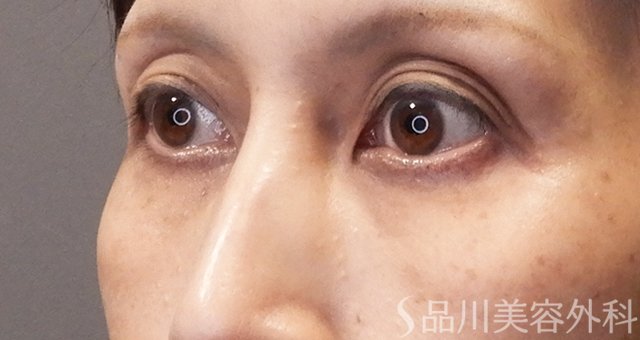 症例NO.67975のBEFORE写真