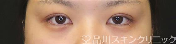 症例NO.60581のAFTER写真