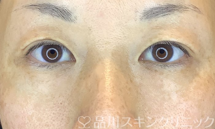 症例NO.70379のBEFORE写真