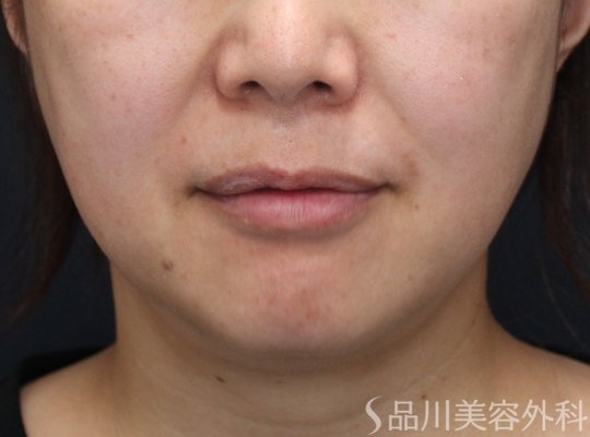 症例NO.74926のBEFORE写真