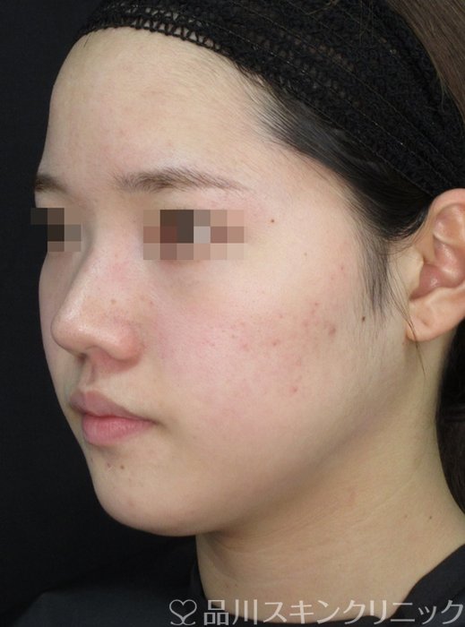 症例NO.72137のAFTER写真