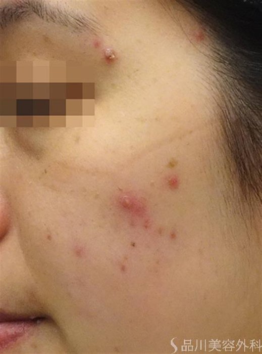 症例NO.25257のBEFORE写真