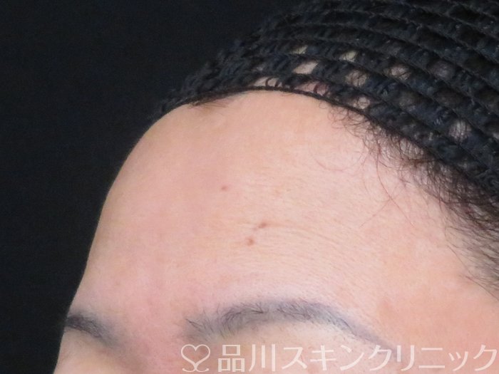 症例NO.69512のBEFORE写真