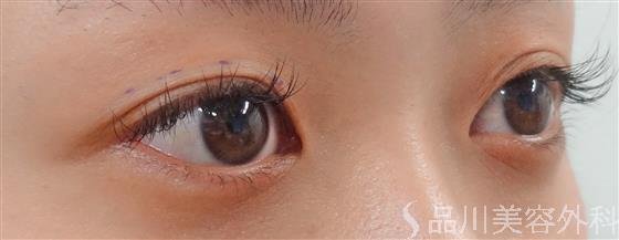 症例NO.24097のBEFORE写真