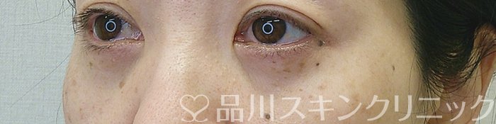 症例NO.69346のAFTER写真