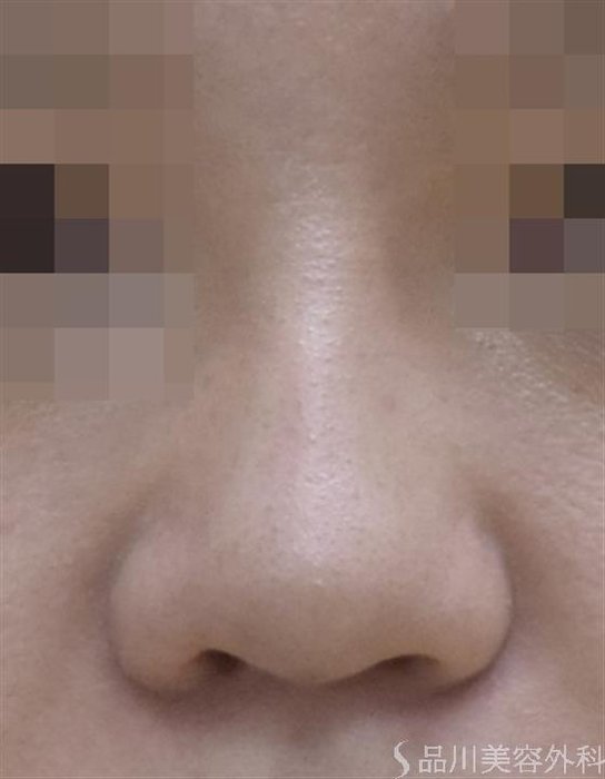 症例NO.48943のAFTER写真
