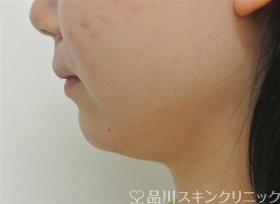症例NO.45818のAFTER写真
