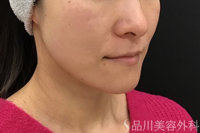 症例NO.71545のAFTER写真
