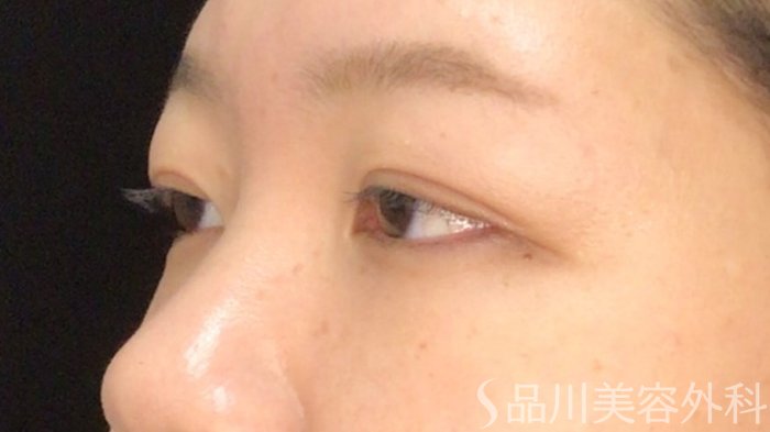 症例NO.71781のAFTER写真