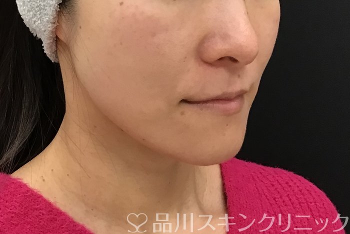 症例NO.71545のAFTER写真