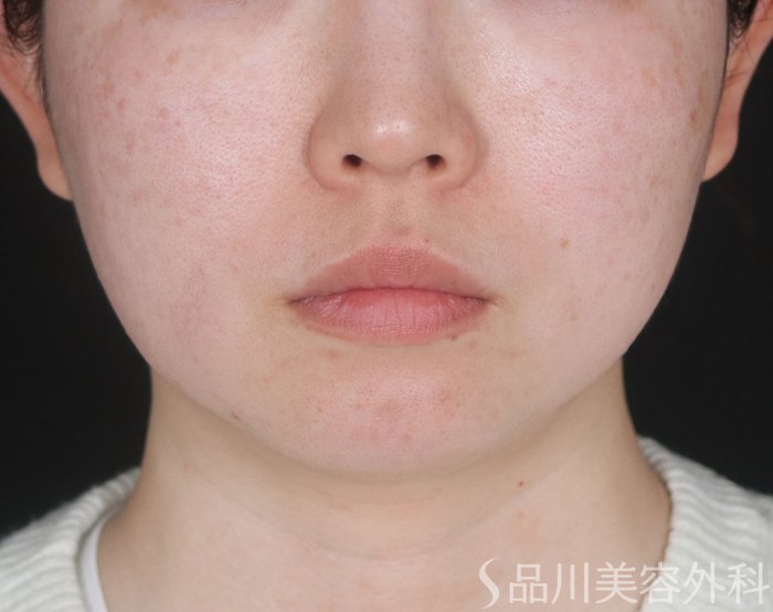 症例NO.73238のBEFORE写真