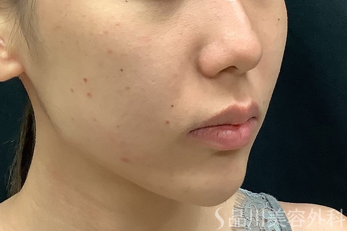 症例NO.67783のBEFORE写真