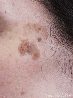 症例NO.72697のBEFORE写真