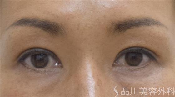 症例NO.55051のAFTER写真