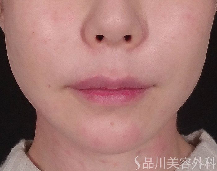 症例NO.69551のAFTER写真