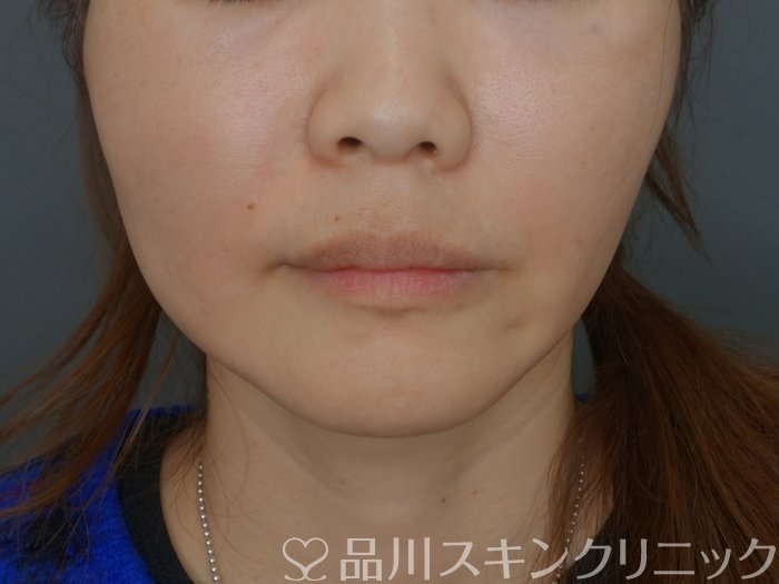 症例NO.74063のAFTER写真