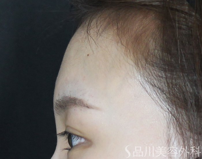 症例NO.65596のBEFORE写真