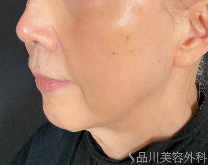 症例NO.75378のBEFORE写真