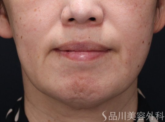 症例NO.72228のBEFORE写真