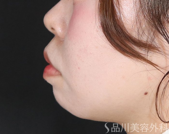 症例NO.72783のBEFORE写真