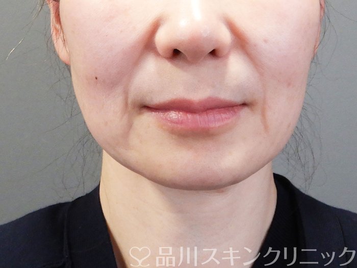 症例NO.74103のBEFORE写真