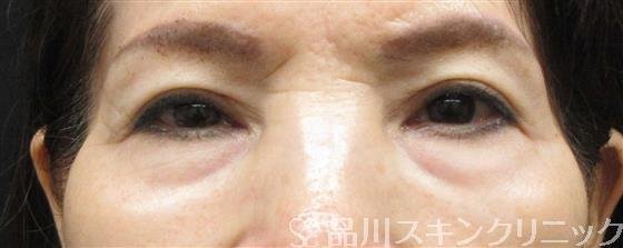 症例NO.61364のBEFORE写真