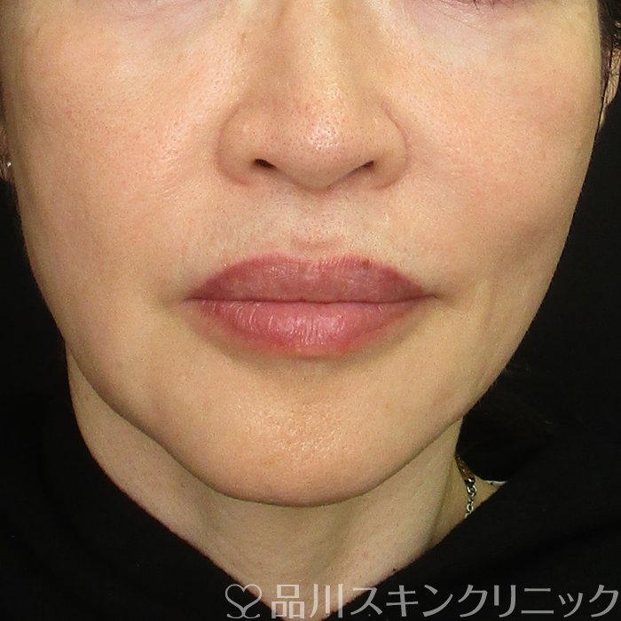 症例NO.70270のBEFORE写真