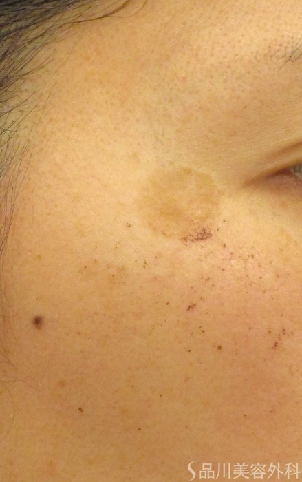 症例NO.65332のBEFORE写真