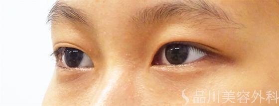 症例NO.54141のBEFORE写真